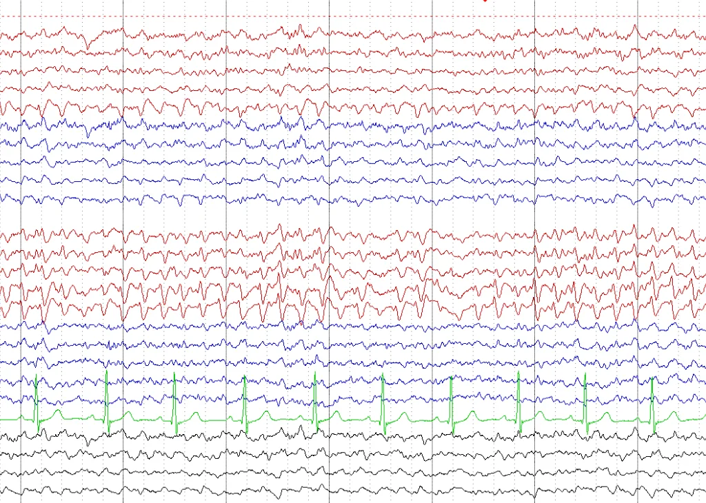 Afbeelding EEG