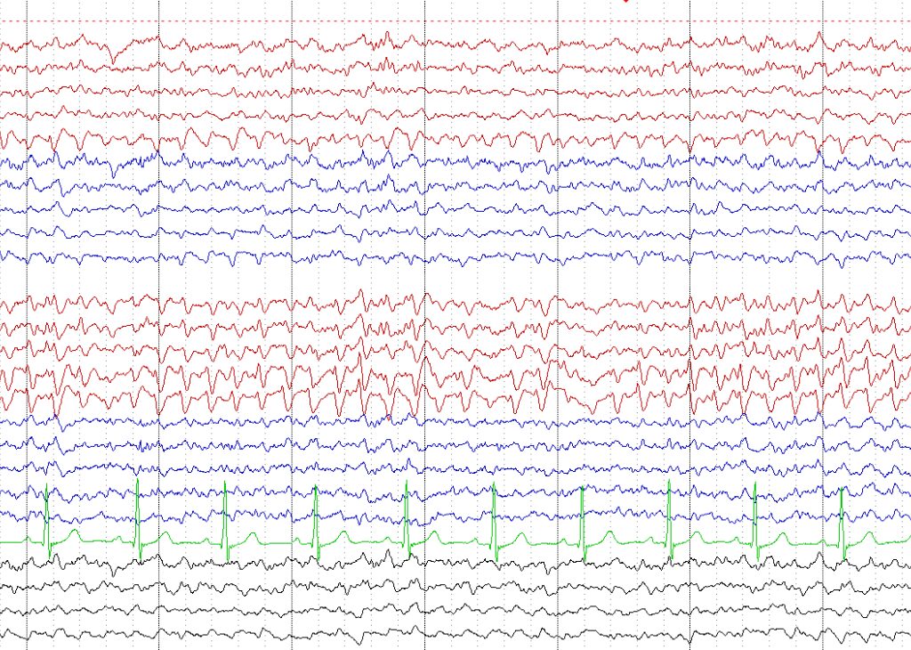 Afbeelding EEG
